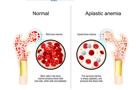<p>Aplastic Anemia <span data-name="drop_of_blood" data-type="emoji">🩸</span></p>