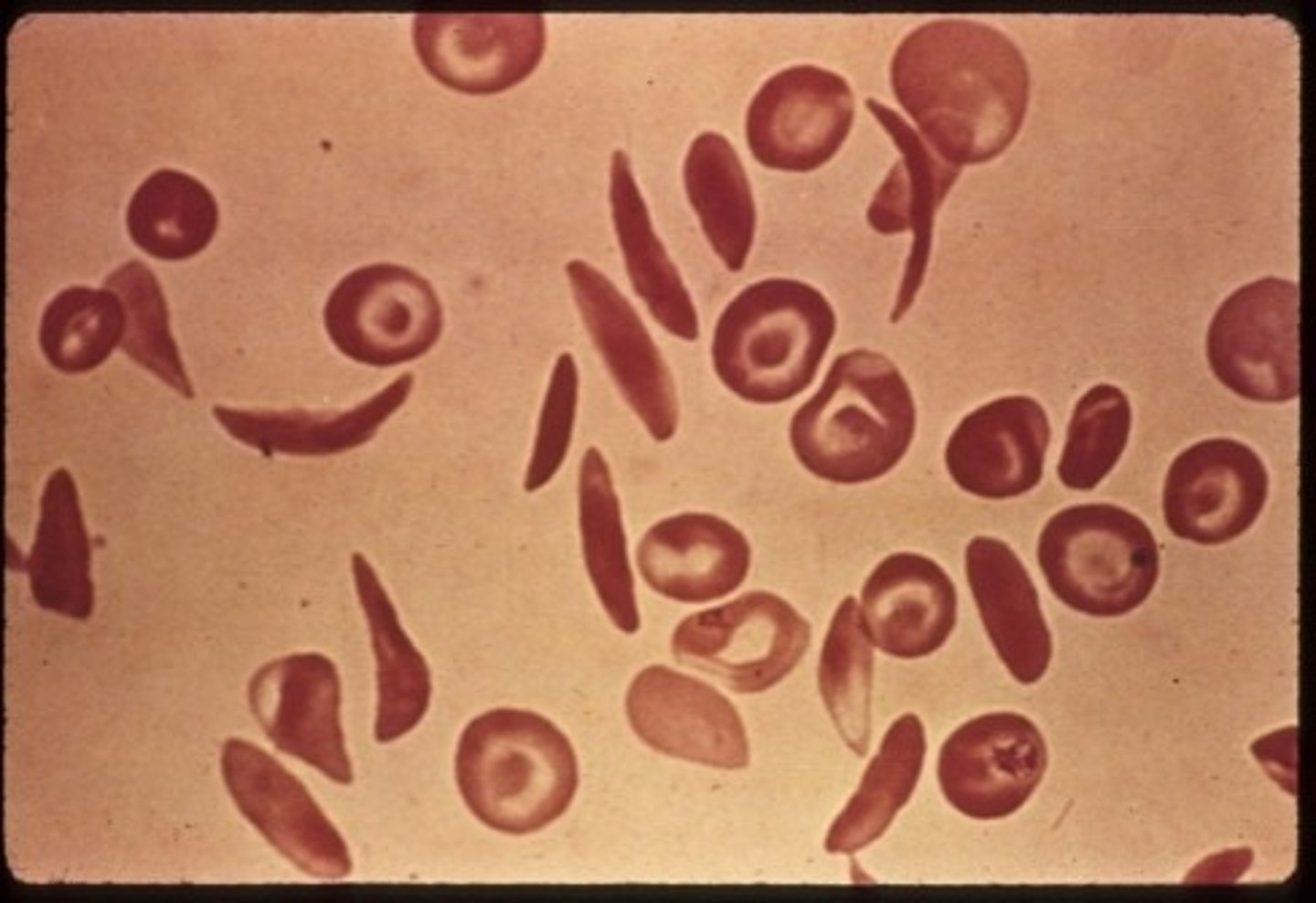 <p>A haemoglobin disorder of quality - HbS polymerises → sickle shaped RBC</p>