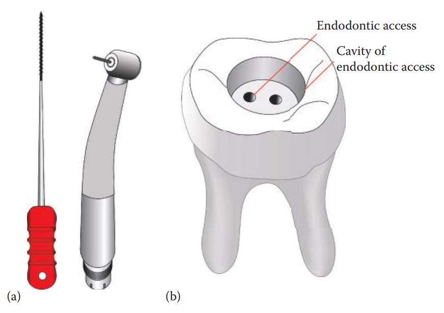 Extraction of pulp tissue using endodontic access procedures: trepanning the occlusal surface of a tooth using a dental bur mounted on a turbine (a), creating a cavity for endodontic access (b), and extracting pulp tissue using a nerve broach (a).