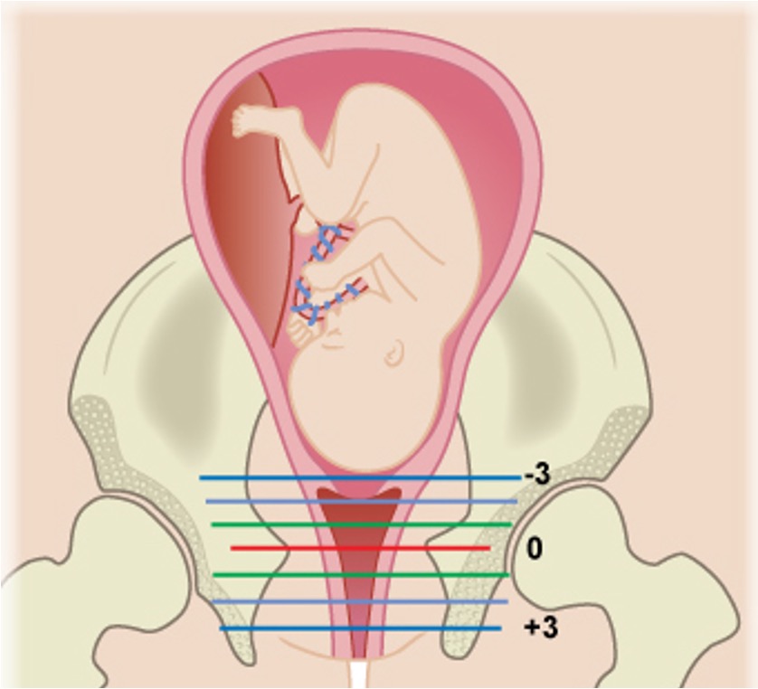 <p>The number of centimeters of the leading bondy edge of the presenting part </p><ul><li><p>measurement of engagement </p></li></ul><p>Measures in distance from ischial spines </p><p></p>