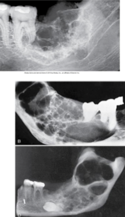 <p>An example of multilocular lesion, can be malignant or benign. Often discovered during routine dental exam. May cause bony expansion. </p>
