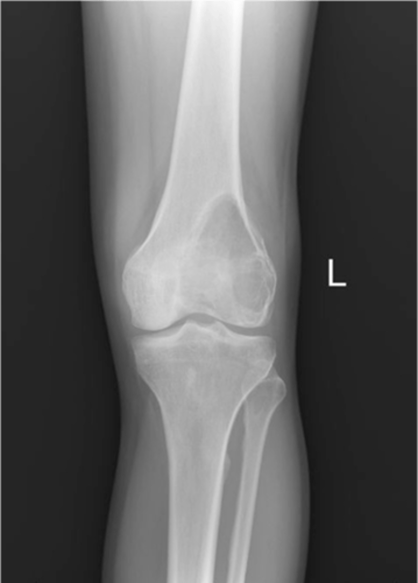 <p>State the clinical features of giant cell tumor</p>