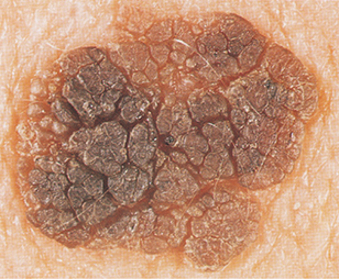 <p>Most common benign epithelial tissue </p><p>Color variable </p><p>Velvety to verrucous </p><p>Can be extensive </p><p>Greasy, stuck on quality </p>