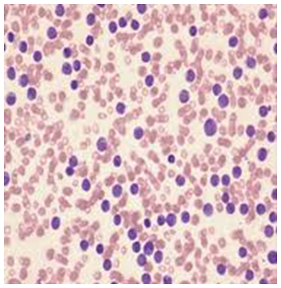 <p>leukocytosis</p>