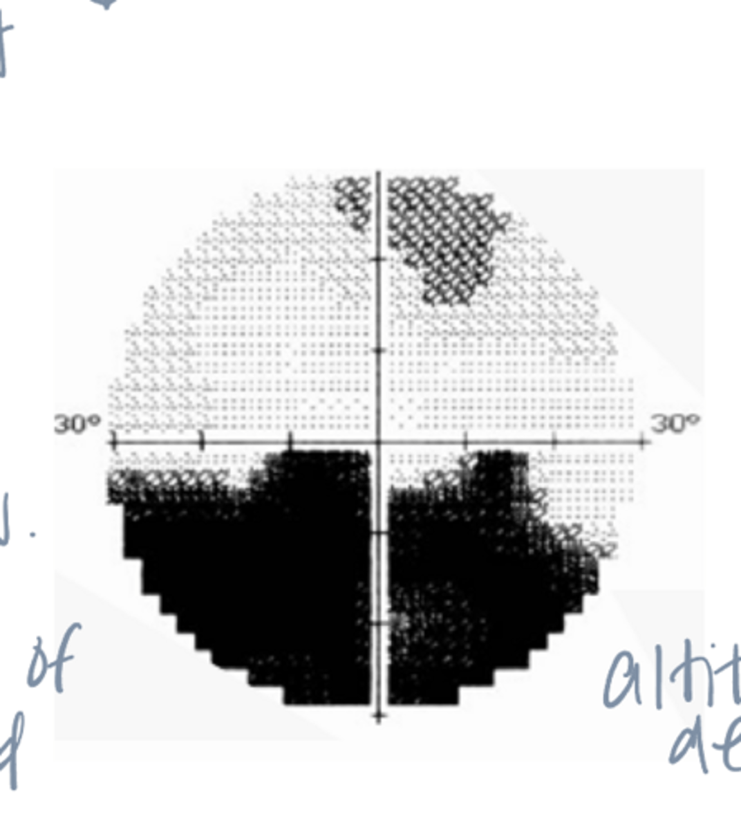 <p>A 55 year old man reports that when he woke up 10 days ago, he noticed problems "seeing out of the bottom of OD." Your associate measured VA and VF while you finish with another patient.</p><p>VA: 20/25 OD; 20/20 OS</p><p>Results of Automated VF testing unremarkable OS. OD VF findings shown.</p><p>Diagnosis?</p>