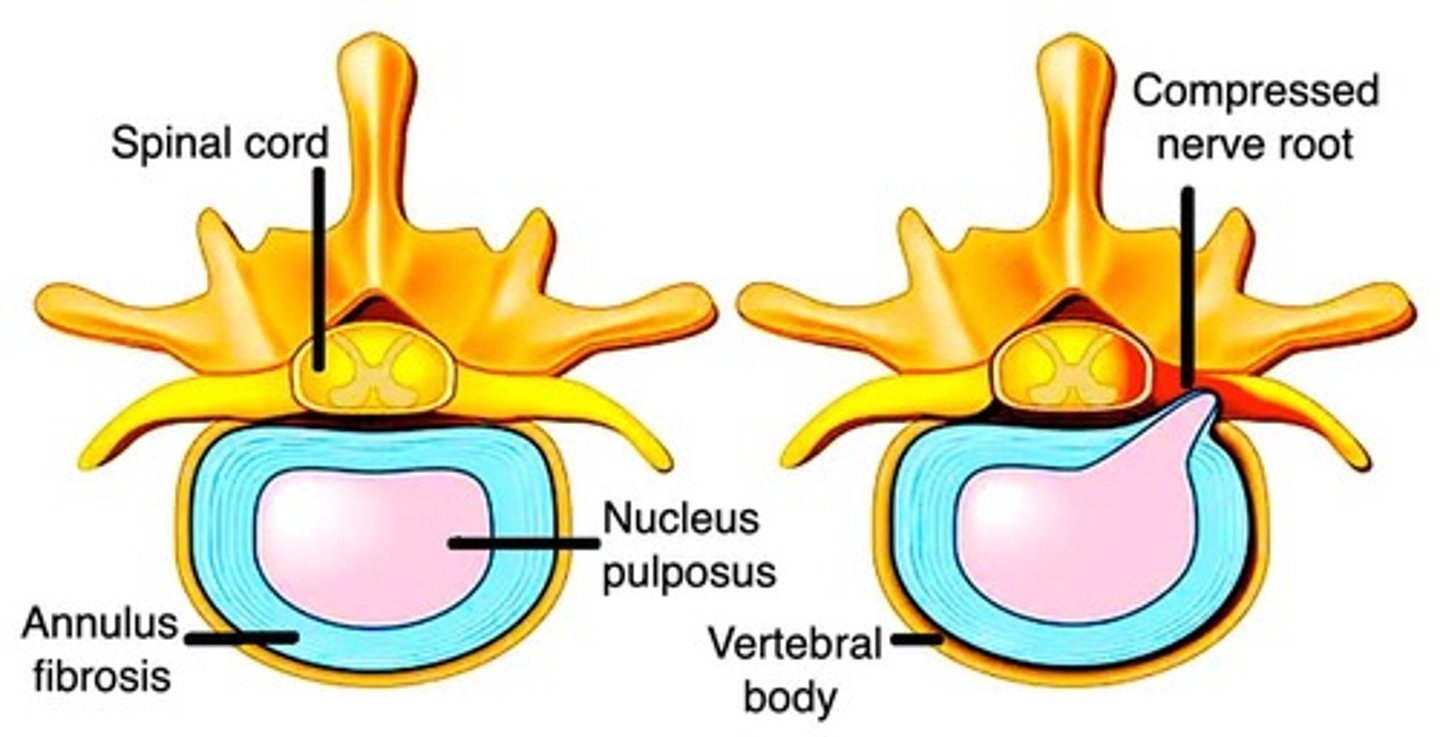 <p>Occurs from HTN, where an atheromatous plaque has launched off.</p>