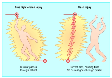 <ul><li><p><strong>True </strong>— electricity really went through the patient</p></li><li><p><strong>Flash </strong>— only happened beside the patient</p></li></ul><p></p>