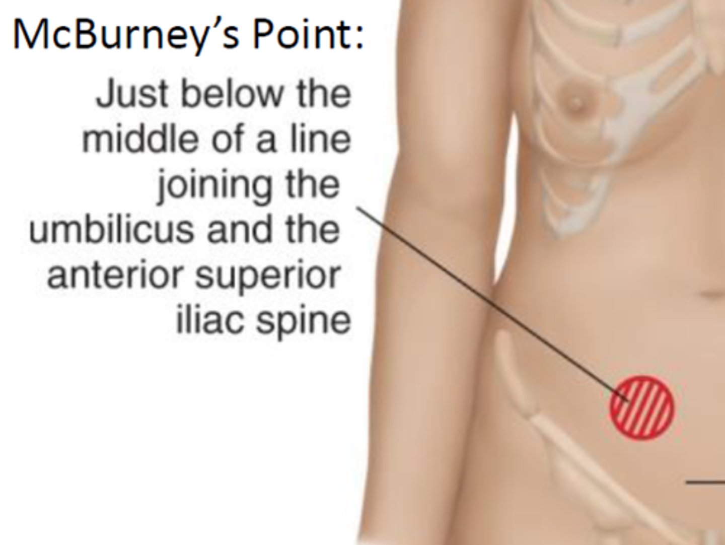 <p>Halfway between the umbilicus and the right ASIS is . This is where palpation causes pain with appendicitis.</p>