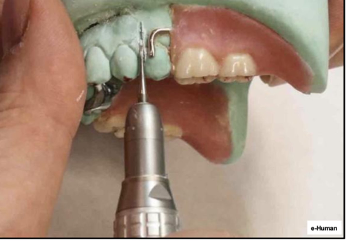 <p>What step of the cold packing technique is this?</p><p>1st: Cut off abutment teeth:</p><p>- A bur is used to cut the grooves through the stone to separate the abutments from the base of the cast.</p><p>- Once the abutments are separated from the base of the cast, sometimes the RPD will come off the base of the cast.</p><p>- Other times, the base of the cast will need to be sectioned</p>