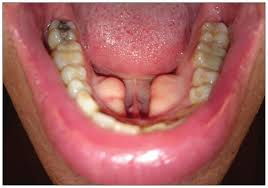 <p>rounded bony overgrowths</p><p>inner surfaces of mandible</p><p>BL</p><p>asx+harmless</p>