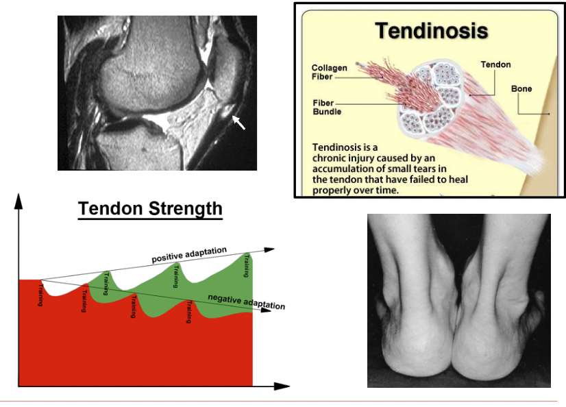 <ul><li><p>Not tendon “itis”, -osis (degenerative changes) or -opathy (symptomatic)</p></li><li><p>MOI: jumping/landing activity: eccentric loading</p></li><li><p>S/S: point tender over tendon, proximal, mid-substance, distal, quadriceps weakness, pain upon loading quads</p></li><li><p>Risk factors: Limited dorsiflexion, muscle weakness (gluteals), tightness of quads, hamstrings and calves</p></li><li><p>4 stages based on duration of symptoms</p><ul><li><p>1: pain after activity, w/o functional limitation</p></li><li><p>2: pain during &amp; after activity, w/o functional limitation</p></li><li><p>3: prolonged pain during &amp; after activity, w functional limitations</p></li><li><p>4: complete tendon tear, requires surgical repair</p></li></ul></li><li><p>Possible Degenerative changes</p><ul><li><p>Chronic attenuation</p></li><li><p>Loss of tensile stregth</p></li><li><p>Mucoid (pockets of fluid, gel like</p></li><li><p>Thickens: Fatty infilitratioon, calcification</p></li></ul></li><li><p>Management: Strengthen quadriceps (eccentric loading), Cho-pat strapping</p></li></ul><p></p>