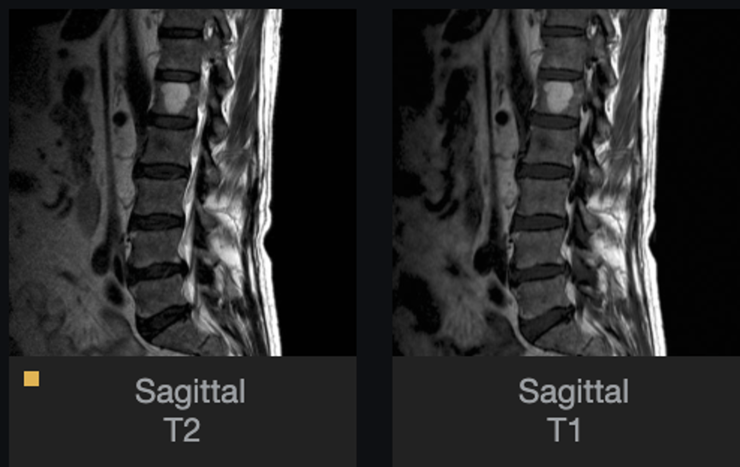<p>What vertebral level is involved?</p>