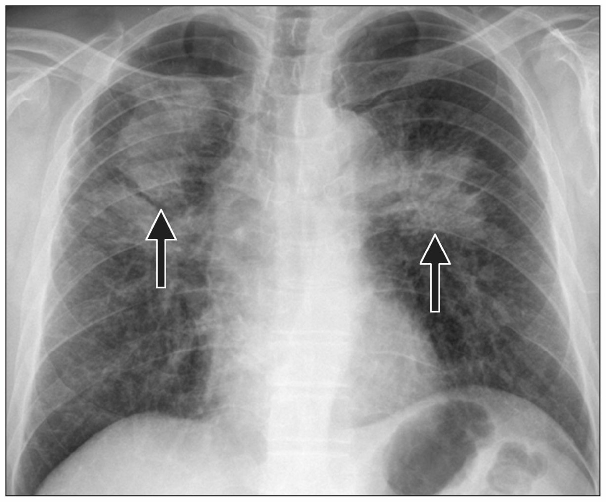 <p>Pneumo<strong>con</strong>iosis</p>