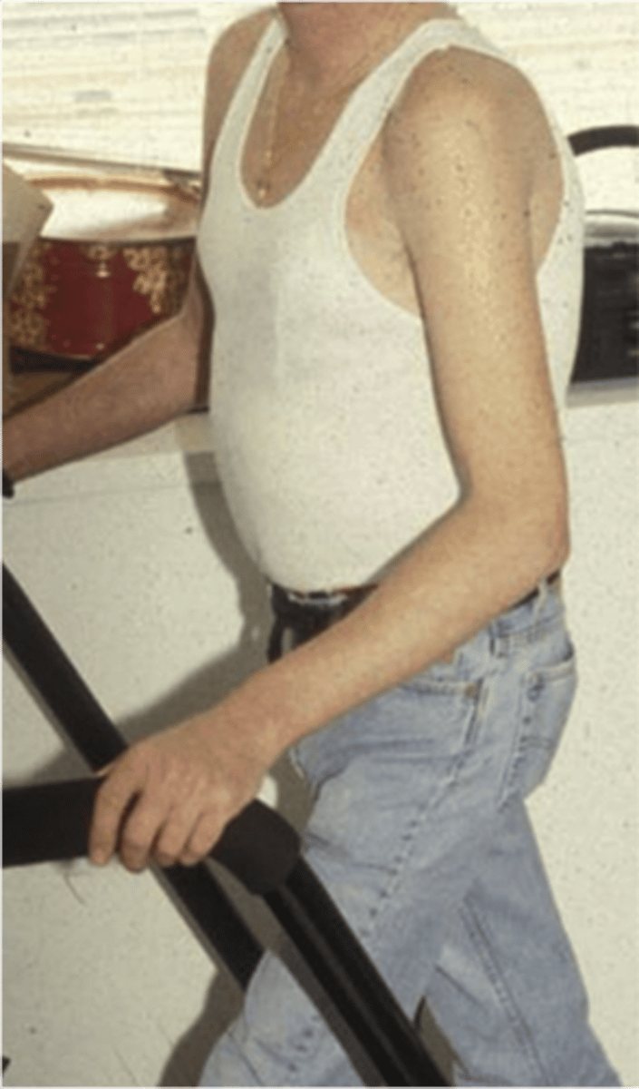 <p>Central fat accumulation. picture of arm (wife beater lol)</p>