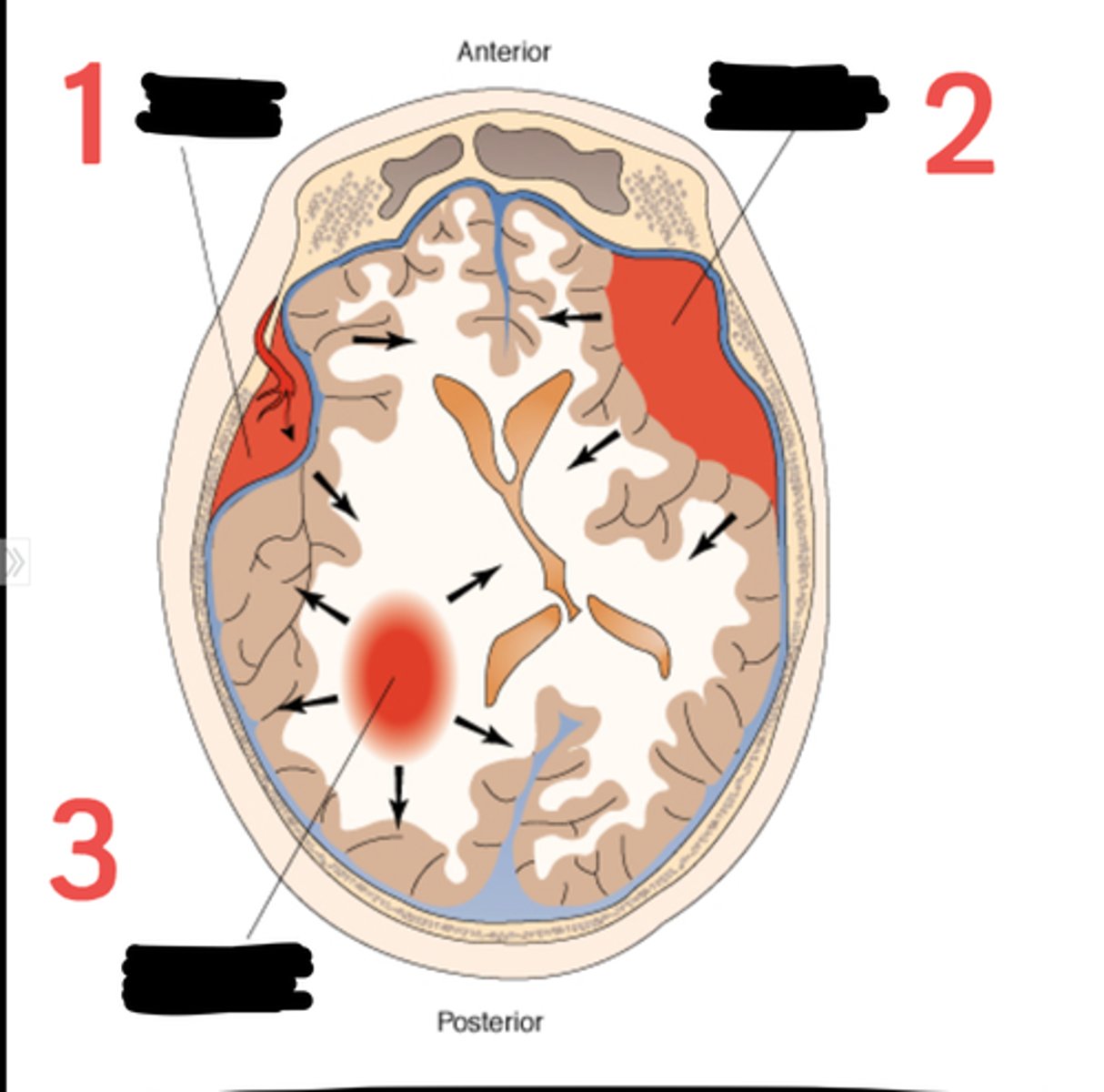 <p>bleeding inside of the cranium is a medical emergency!</p><p>-Commonly caused by trauma, hemorrhagic stroke, ruptured aneurysm</p><p>-<strong>Increased ICP</strong> results from hemorrhage, surrounding edema or hydrocephalus due to obstruction of CSF</p><p>-<strong>Three types: Epidural, Subdural, and Subarachnoid</strong></p><p>- may affect vision causing diplopia, blurred vision, photophobia</p>
