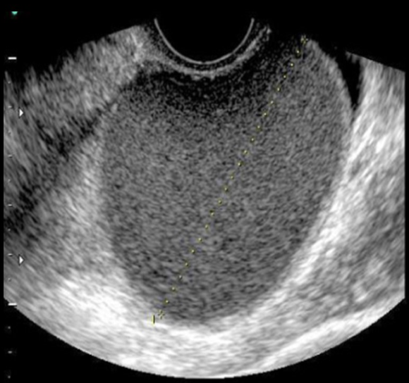 <p>a 20 yo has dysmenorrhea + menorrhagia. she says her menstrual cycle occurs every 28 days + LMP was 21 days ago. </p><p>a) hematometrocolpos</p><p>b) endometrioma</p><p>c) andeocarcinoma</p><p>d) pyosalpinx </p>