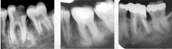 <p>Focal (chronic) sclerosing osteomyelitis —&gt; large restoration, caries, and infection</p>