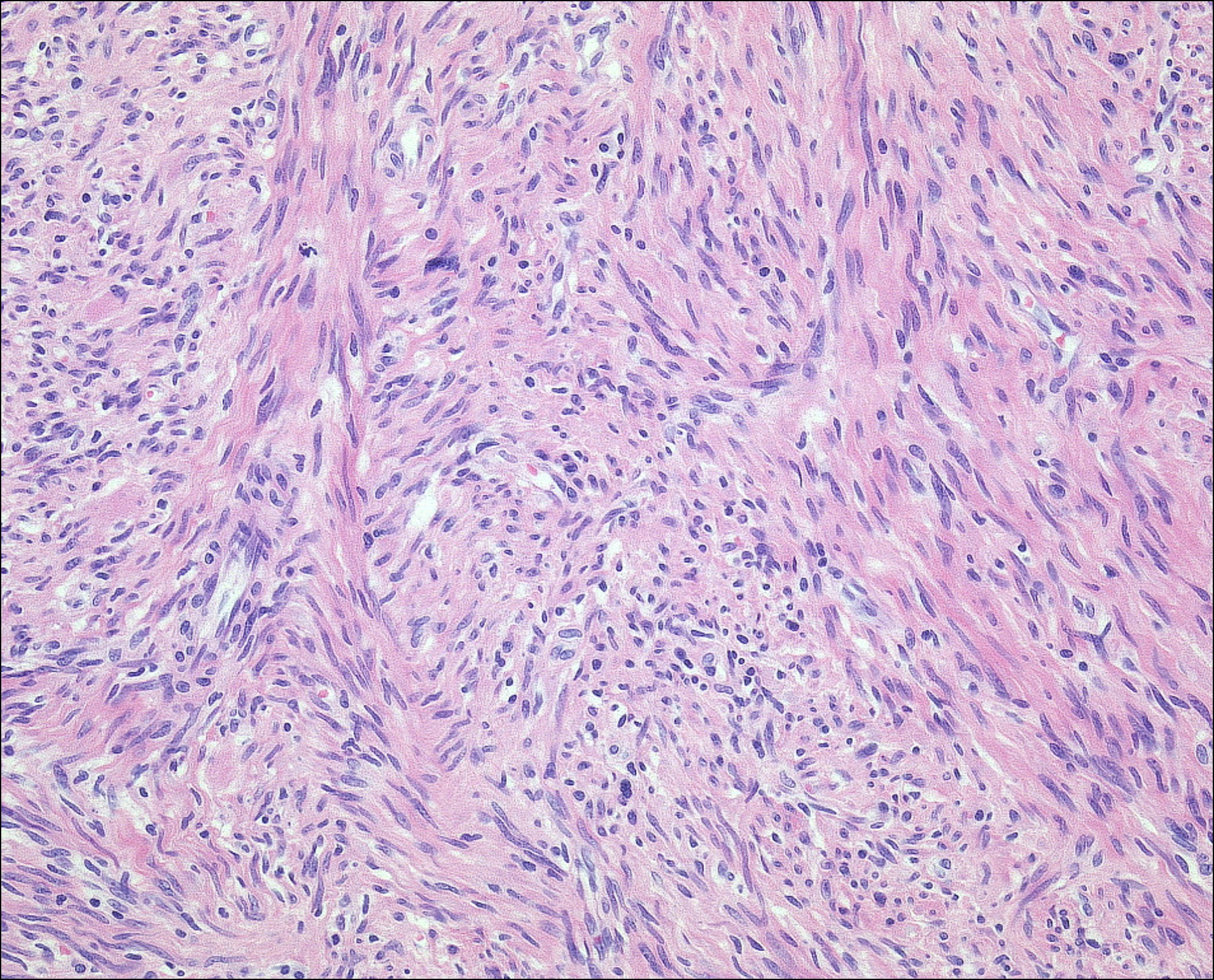 <p>Patient de 50 ans avec masse ORL profonde </p><p>1) diagnostic </p><p>2) localisation et population</p><p>3) Histologie </p><p>4) IHC </p><p>5) DD </p>