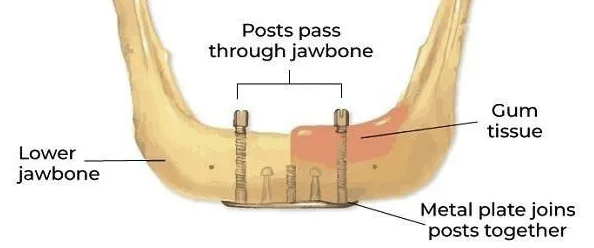 <p>What are transosseous implants (transosteal, staple, transmandibular)?</p>