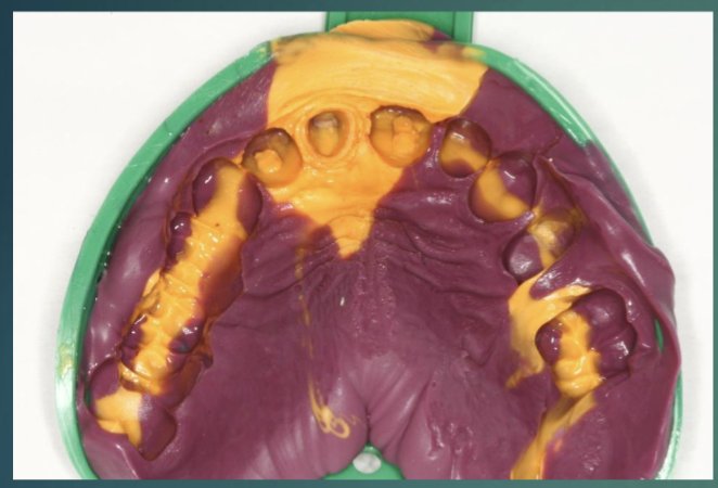 <ul><li><p>use provisional restoration as impression coping </p></li><li><p>make VPS HB/RB impression w the provisional crowns seated </p></li></ul><p></p>
