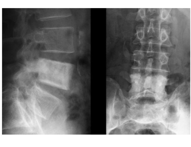 <ul><li><p>condensation diffuse d’un corps vertébral </p></li><li><p>Vertèbre «&nbsp;ivoire&nbsp;» </p></li></ul><p></p>