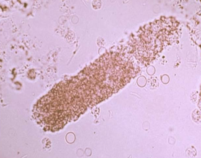 <p>What type of cast is this?</p><p>What is a granular cast made up of?</p>