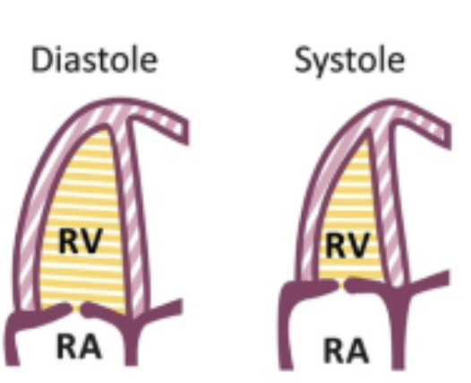 <p>Using 2D at <strong>AP4</strong>, trace at the TV annulus, along the wall to the apex, down the IVS, and back to the annulus</p><ul><li><p>Perform this in end-diastole AND end-systole</p></li></ul><p></p>