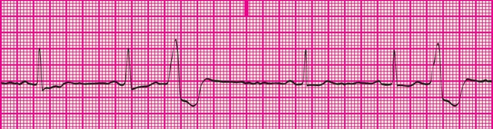 <p>a pattern of PVCs in which every 3rd complex is a PVC</p>