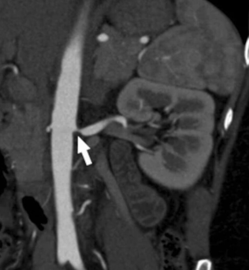 <p>MRI for blood vessels</p><p>No contrast (kidney injury)</p>