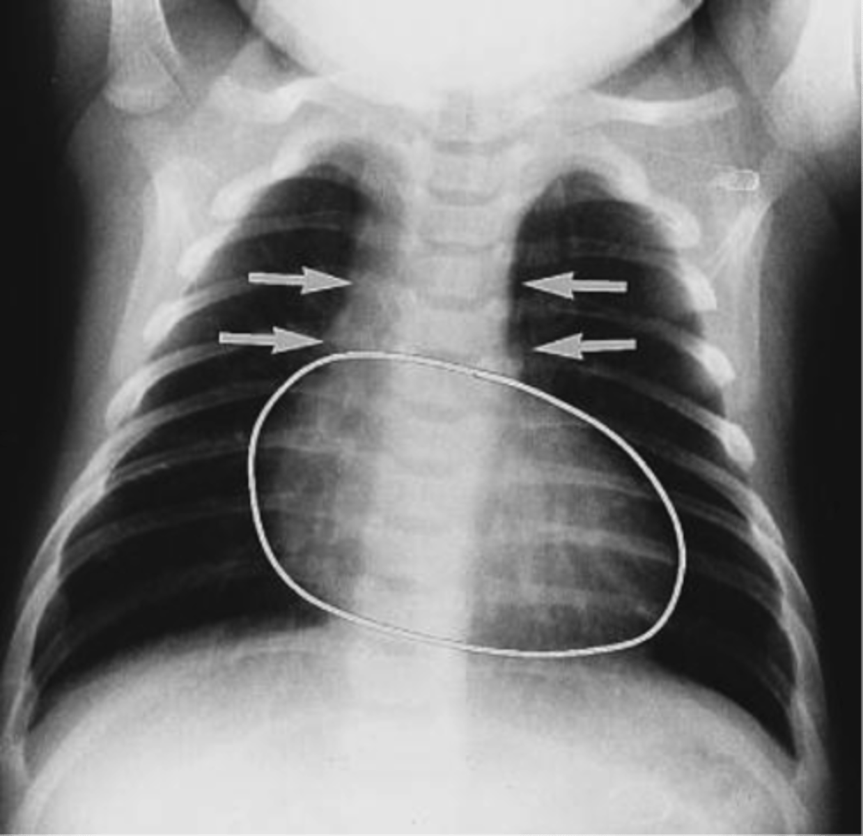 <p>Transposition of the great vessels</p><p>- egg-on-a-string heart</p><p>- Prostaglandins initiated to keep ductus arteriosus patent, ECHO obtained</p>