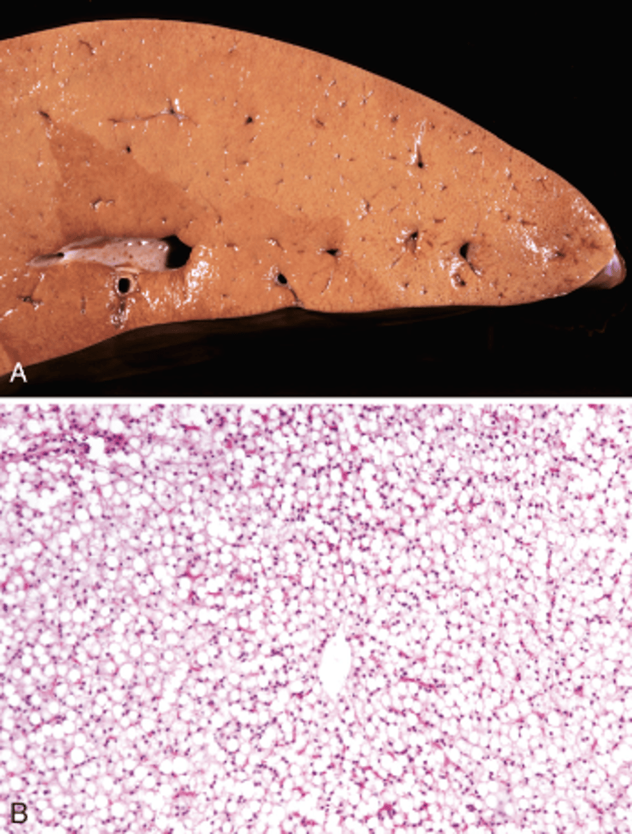<p>What type of reversible cell injury is shown in these images?</p>