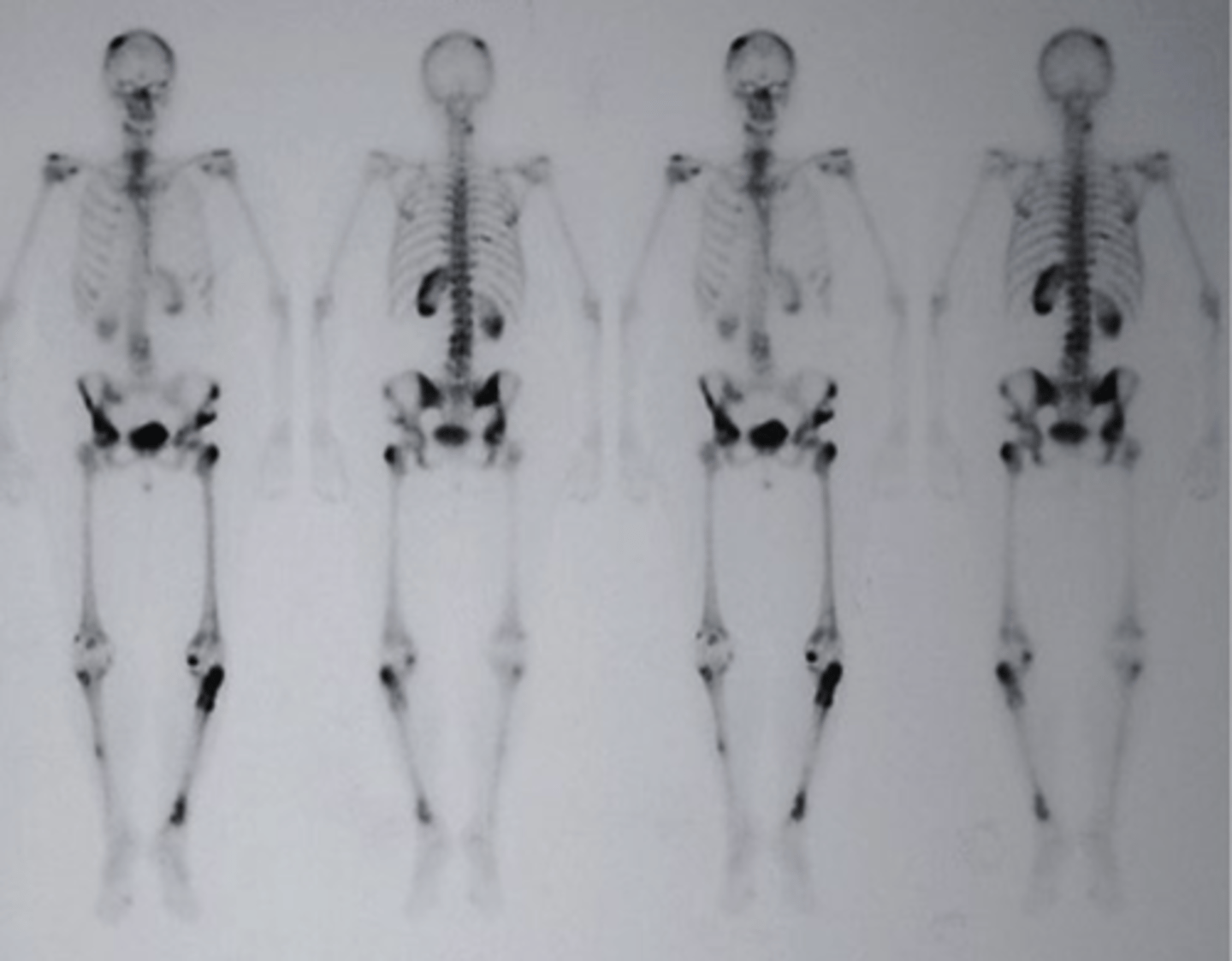 <p>which of the following would be the correctly associated image findings?</p><p>a. bone fracture</p><p>b. epiphyseal plates</p><p>c. multiple skeletal metastases</p><p>d. Blood Clots</p>