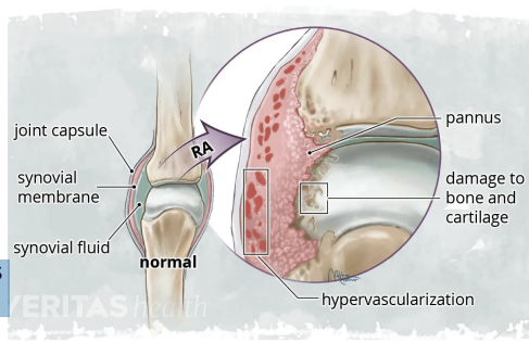 <ol><li><p><strong>Joint Pathology </strong>- Autoimmune responses targets the <strong>synovium </strong>resulting in <mark data-color="#e0ffe9" style="background-color: rgb(224, 255, 233); color: inherit;">pannus </mark>formation (abnormal fibrovascular tissue), <strong>joint deformity &amp; loss of function</strong></p></li><li><p>joint pain lasting more than 1 hour- <strong>symmetrical </strong>joint pain and swelling&nbsp;</p></li><li><p><strong>Genetic Factors </strong>- HLA-DR4 / HLA-DRB1 shared epitope alleles influence antigen presentation</p></li><li><p><strong>Autoantibodies </strong>- Rheumatoid Factor (RF): antibody against <strong>Fc portion of IgG</strong> <mark data-color="#d1ffd5" style="background-color: rgb(209, 255, 213); color: inherit;">- Anti-CCP antibodies: highly specific, appear </mark><strong><mark data-color="#d1ffd5" style="background-color: rgb(209, 255, 213); color: inherit;">years before symptoms</mark></strong></p></li><li><p><strong>Immune Cell Contributions</strong></p></li></ol><ul><li><p>CD4+ T cells: release cytokines (TNF-α, IL-1, IL-6) that drive inflammation</p></li><li><p>B cells: produce autoantibodies &amp; act as antigen-presenting cells</p></li><li><p>Macrophages: amplify cytokine production</p></li><li><p>Osteoclasts: mediate bone erosion</p></li></ul><p></p>