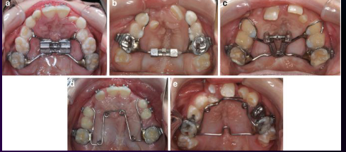<p><span><strong>• Majority of children with cleft lip and palate require orthodontic care </strong></span></p><p><span><strong>• Ortho treatment may be required after each stage of surgical treatment for cleft palate </strong></span></p>