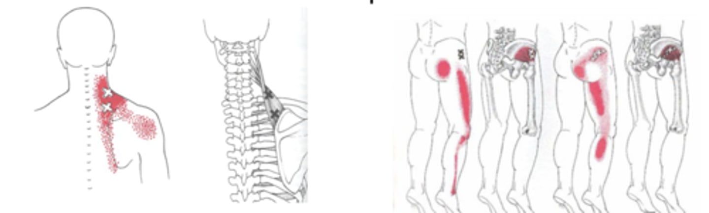 <p>Sensitized nociceptors described as DEEP ACHING PAIN</p><p>- Present w/ common referral factors</p>
