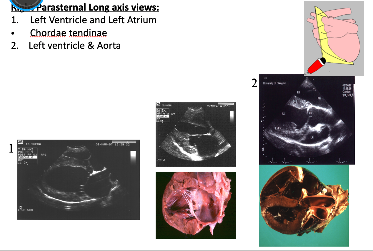 <ul><li><p>Hyper echoic strands = chordae tendinae</p></li></ul><p></p>