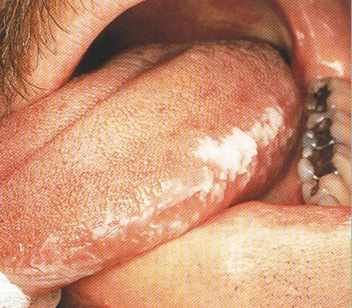 <p>Oral hairy leukoplakia </p>