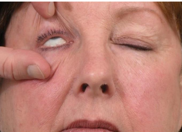 <p>Reflex between facial and oculomotor nuclei</p><p>Eye closes → Eye rotates upward and outward</p><p>Protective mechanism</p>