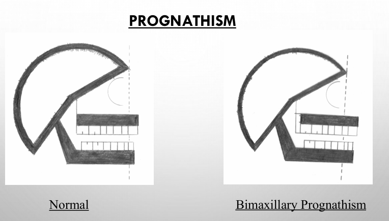 <p>-prognathism is a skeletal protrusion</p><p>-bimaxillary prognathism (protrusion): present when both jaws protrude forward of the normal facial limits (very convex)</p><p>-maxillary prognathism (protrusion): present when the maxilla protrudes forward of the normal limits of the face; usually seen in class II skeletal patterns</p><p>-mandibular prognathism (protrusion): when the mandible protrudes forward of the normal limits of the face; seen in class III skeletal patterns</p>