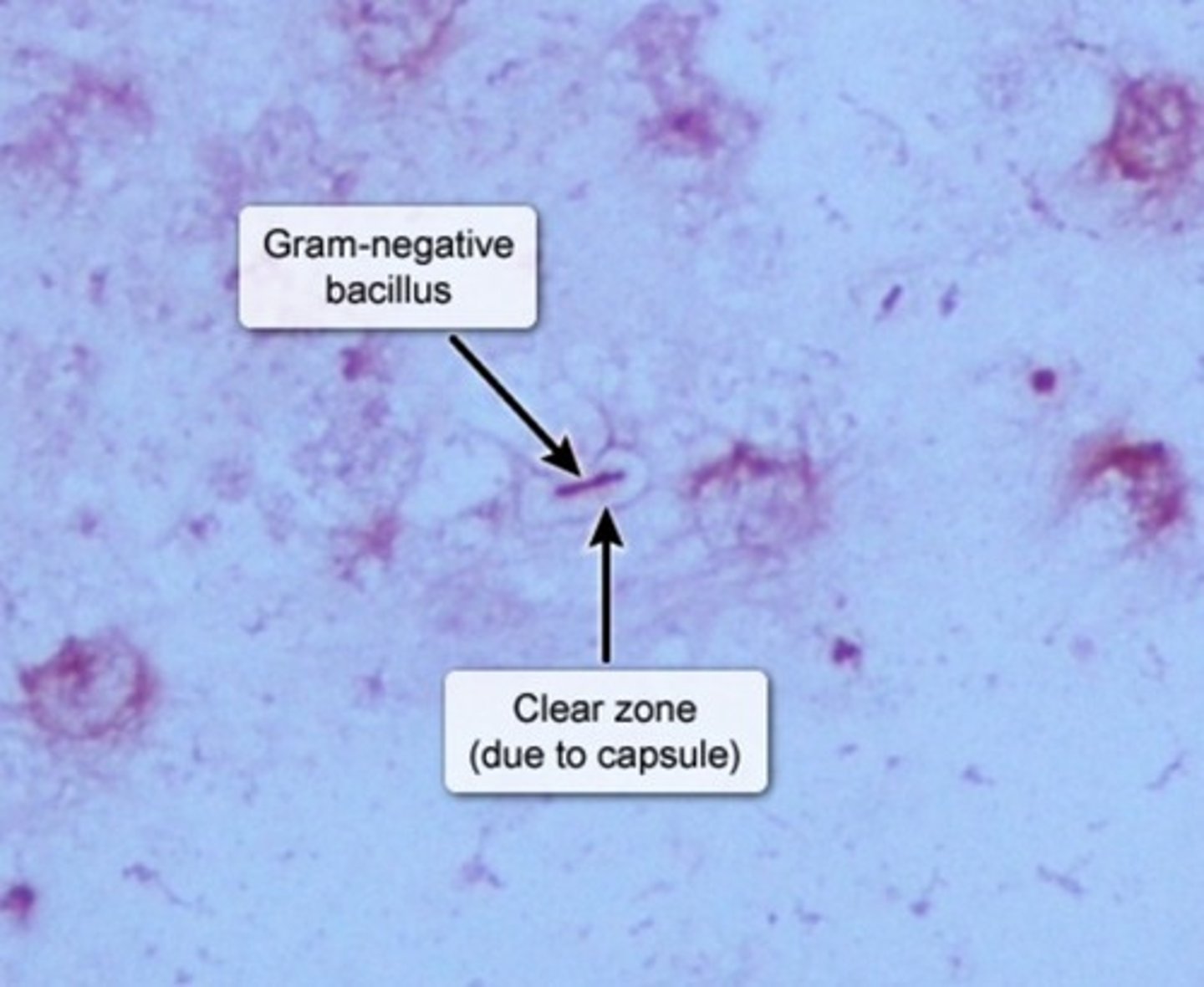 <p>Gram "-" Rod</p><p>Urease "+"</p><p>Risk Factors</p><p>-Alcohol use</p><p>-DM</p><p>Sx</p><p>-Currant Jelly sputum</p><p>-UTIs</p><p>-Pneumonia</p>