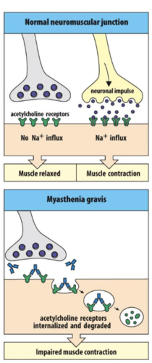 <p>A: Antibodies bind to acetylcholine receptors</p><p>on muscle cells, this will Inhibit signaling from nerve to muscle</p><p>progessive muscle weakening will lead to chest muscle weaking ythat impairs breathing</p><p>Type II: Myasthenia Gravis which is aggressive weakening of neuromuscular junction</p>