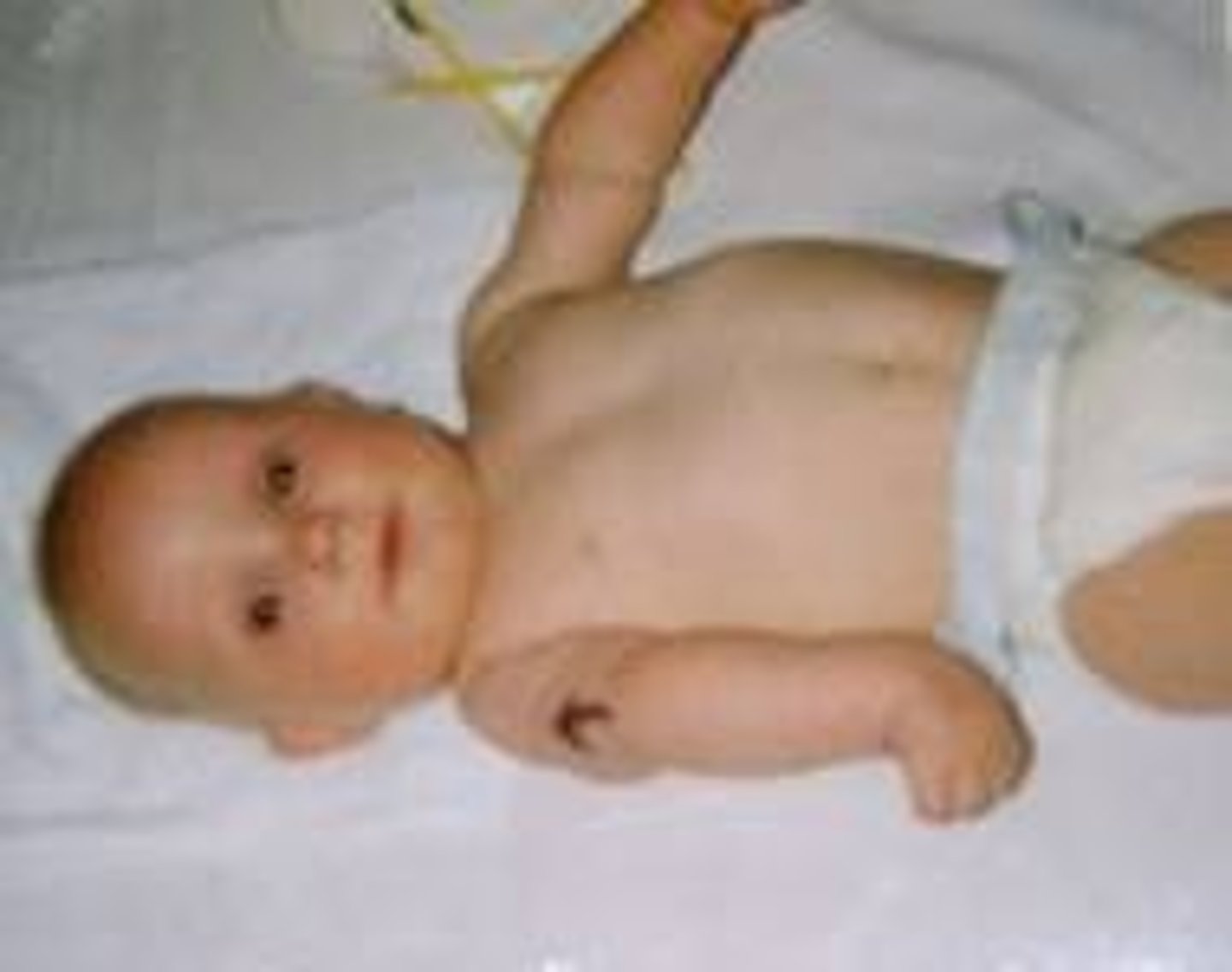 <p>Maternal: PPH, 3rd/4th degree tears, symphyseal injury, uterine rupture (rare).</p><p>Fetal: Brachial plexus injury (Erb palsy C5-6 brachial plexus), clavicle/humerus fracture, hypoxia, HIE hypoxic ischemic ecephalopathy, death.</p>