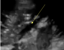 <p>How would the IVC appear in the case of hypovolemia?</p><p>*hypovolemic or distributive shock</p>