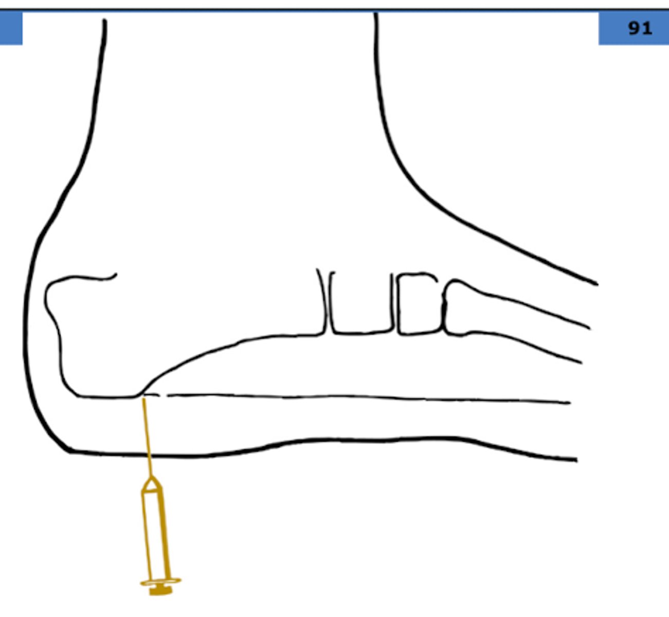 <p>NSAIDs</p><p>Ice</p><p>PT</p><p>Ortho → steroid injections</p>