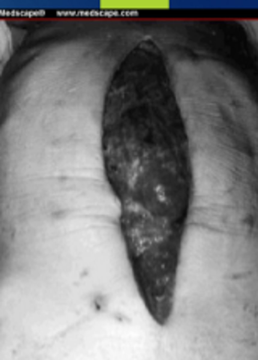 <p>-partial or total disruption of any layer of the wound</p><p><strong>-MC on POD 5-8</strong></p>