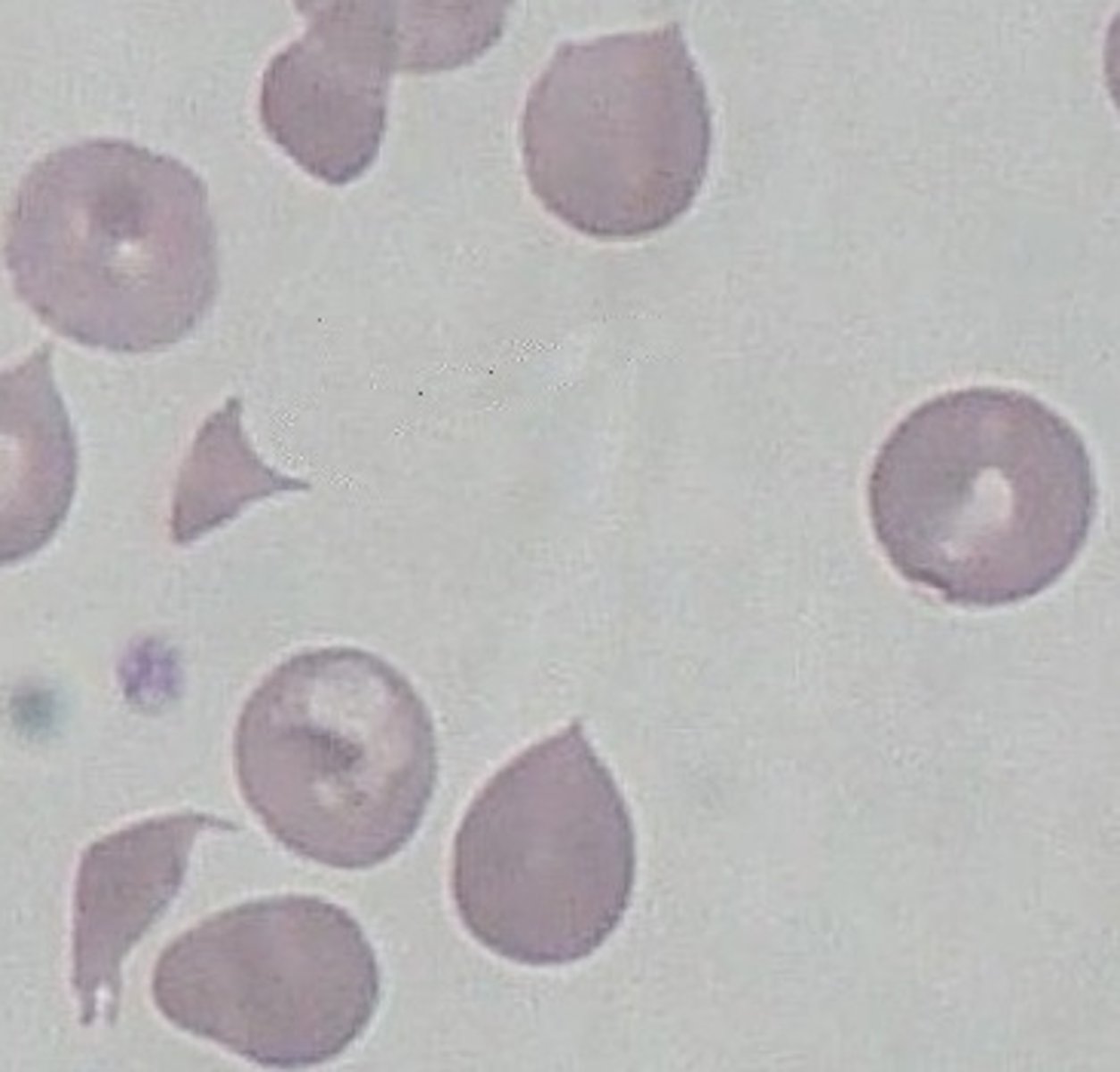 <p>Intravascular haemolysis</p><p>Mechanical heart valve</p><p>Disseminated intravascular coagulation</p>