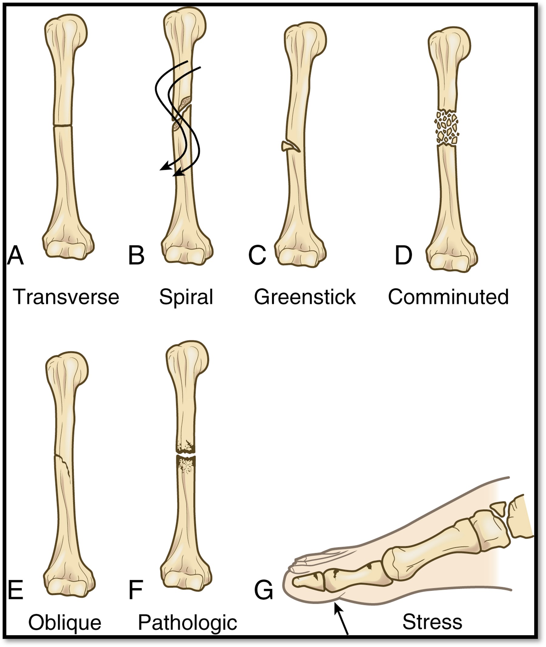 <p>Fractures ( what is it? and Classifications?)</p>