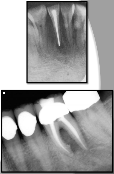 <p>Silver points are used to obliterate pulp canals and appear more radiodense than gutta percha on a xray film. </p><ul><li><p>used in endodontics </p></li></ul><p></p>