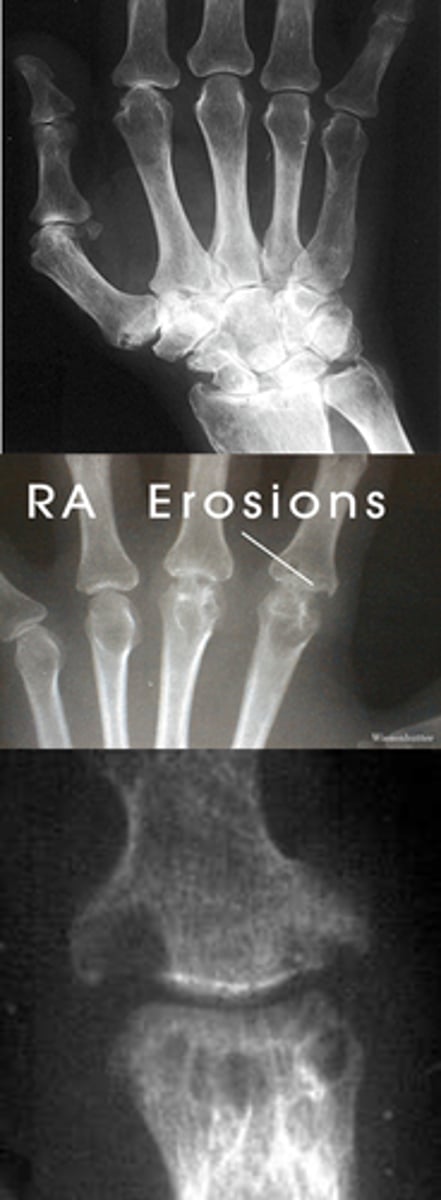 <p>radiologic tests show:</p><p>- joint space narrowing</p><p>- soft tissue swelling</p><p>- bony erosions</p>