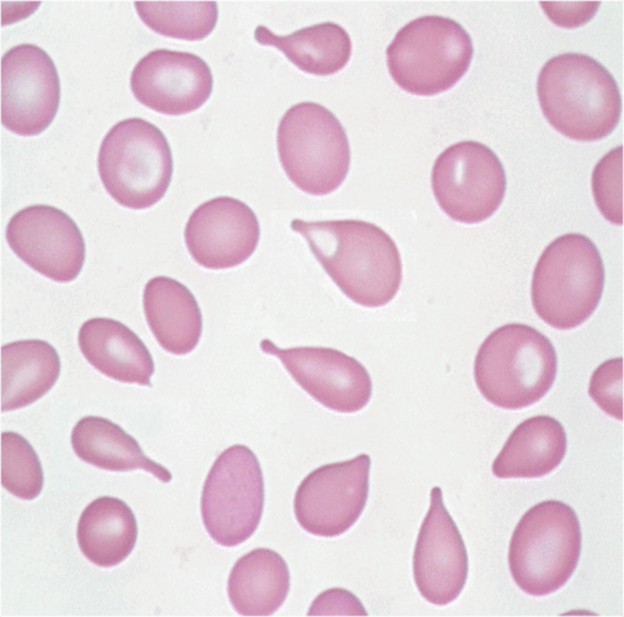 <p>squeezing of RBCs, crowded BM or spleen</p><p>- splenomegaly</p><p>- MDS</p><p>- Severe anemia</p><p>- Fibrosis</p>